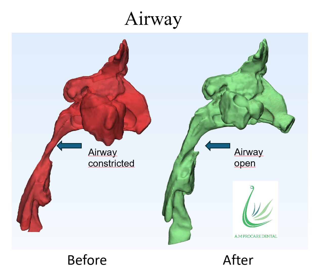 Snoring and mouth opening/breathing during sleep can be signs of severe sleep apnea