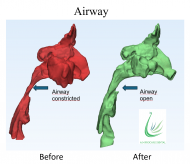 Snoring and mouth opening/breathing during sleep can be signs of severe sleep apnea